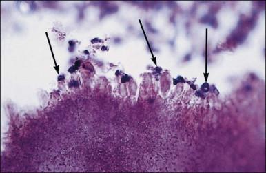 Figure 16.6, Intrauterine device. Actinomyces . Sulfur granule with clubs (arrows).