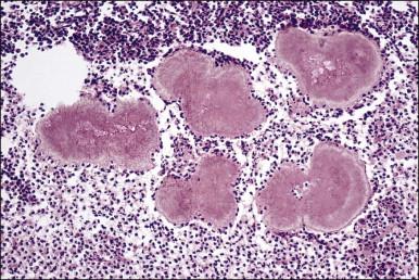 Figure 16.7, Intrauterine device. Actinomyces . Sulfur granules surrounded by pus.