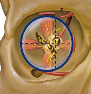 Fig. 20.1, Illustration of the limits of the intraconal space (continuous blue line). The horizontal and vertical dashed lines that cross the optic nerve divide the intraconal space in superior/inferior and lateral/medial, respectively.