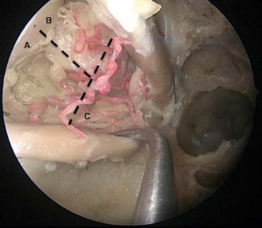 Fig. 20.2, Endoscopic view of the medial intraconal space divided into three conceptual zones A, B, and C by the inferomedial muscular trunk of the ophthalmic artery.