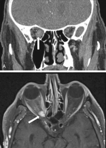 Fig. 20.3, (A) Coronal computed tomography (CT) scan and (B) axial magnetic resonance imaging (MRI) of a right orbital apex cavernous hemangioma (white arrow) and its relationship with the surrounding bony and neurovascular structures.