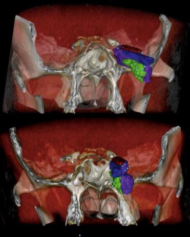 Fig. 20.4, Two views of a three-dimensional (3D) reconstruction showing the optic nerve (blue), medial (green) and lateral (purple) aspects of the tumor based on the optic nerve and inside the plane of resectability (dashed lines) , and the aspect of the tumor that is outside the plane of resectability (red).