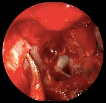 Fig. 20.5, Endoscopic view of the right orbit demonstrating the removal of the lamina papyracea with a double-ball probe.