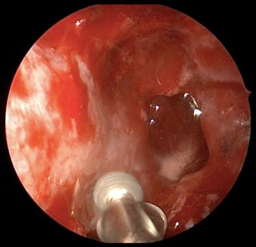 Fig. 20.6, Endoscopic view of the right orbit with the orbital process of the palatine bone being drilled.