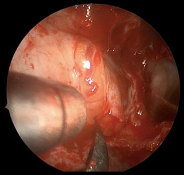 Fig. 20.7, Endoscopic view of the right orbit showing the reverse “hockey stick”–shaped incision of the periorbita with a sickle knife.