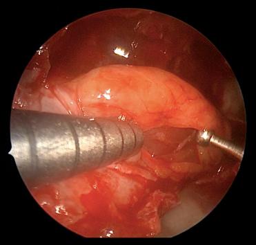 Fig. 20.8, Endoscopic view of the right orbit with extraconal fat dissection.