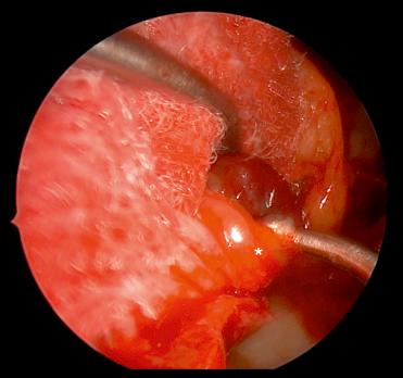 Fig. 20.9, Endoscopic view of the right orbit showing the medial rectus (asterisk) muscle retraction with a double-ball probe and the tumor exposure using a neuropatty.