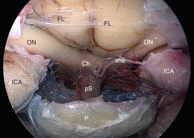 Figure 48.1, Image of a specimen showing the anatomy of the intra- and suprasellar area. Ch, optic chiasm; FL, frontal lobe; ICA, internal carotid artery; ON, optic nerve; P, pituitary gland; pS, pituitary stalk; sha, superior hypophyseal artery.
