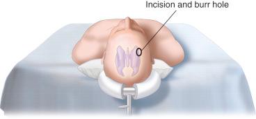 Figure 16.1, Patient position.