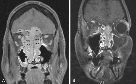 Fig. 25.1, Tumor extent is the main determinant of the feasibility of performing an endoscopic craniofacial resection (CFR) with successful complete tumor resection. (A) Coronal T1-weighted contrast-enhanced magnetic resonance image (MRI) of a sinonasal mass with massive intracranial extension (single asterisks) and periorbital involvement (double asterisks). This tumor, with its wide dural involvement, would be better treated using an open craniotomy approach. (B) Coronal MRI of a different paranasal mass. Note that this mass also invades the periorbita as well as the dura but still may be amenable to endoscopic CFR.