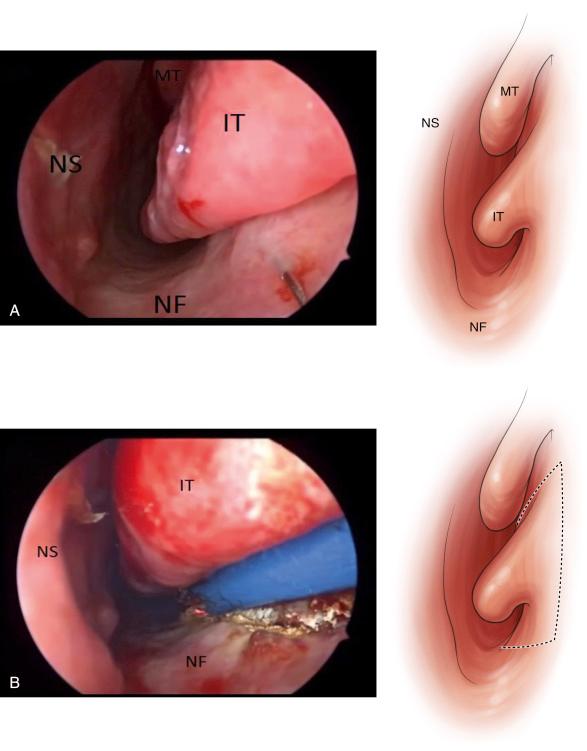 Fig. 22.1, (A) Anatomy of the left nasal cavity. (B) Intranasal incisions are made with cautery along the dotted lines and carried through the periosteum. Specifically, an inferior incision is made at the junction of the nasal floor and lateral nasal wall, followed by a superior incision along the lateral nasal wall and anteriorly overlying the pyriform aperture. IT, Inferior turbinate; M, middle turbinate; NF, nasal floor; NS, nasal septum.