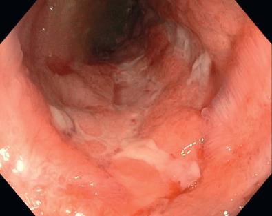 FIG 38.1, Cobblestoning mucosa in active Crohn's disease.