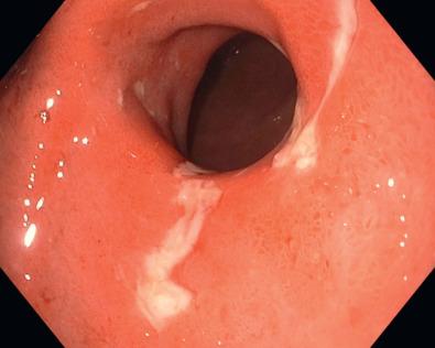 FIG 38.2, Multiple serpiginous ulcers in a patient with Crohn's disease.