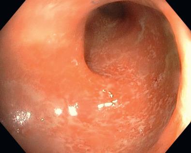 FIG 38.3, Crohn's colitis with aphthous ulcerations and white exudate.