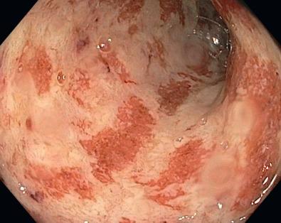 FIG 38.4, Ulcerative colitis with superficial ulceration, edema, and mucosal friability extending in a confluent manner starting from the rectum.