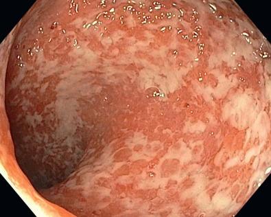 FIG 38.5, Colitis with superficial ulceration and edema. This appearance can be seen in both Crohn's colitis and ulcerative colitis.