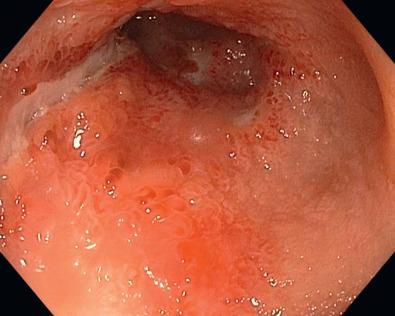 FIG 38.6, A patient with ileitis due to Crohn's disease with erythema, edema, and ulceration of the terminal ileum.