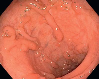 FIG 38.7, Pseudopolyps in a patient with ulcerative colitis.