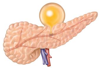 FIG 56.1, Illustration of the mechanism of formation of an acute pancreatic pseudocyst. Limited necrosis of the main pancreatic duct produces a ductal leak with accumulation of amylase-rich fluid.