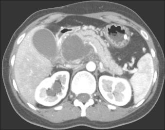 FIG 56.3, Metastatic malignant fibrous histiocytoma detected in a woman with abdominal pain and “pancreatitis” mimicking a pancreatic pseudocyst. She had a previous known primary lesion. The lesion was diagnosed by endoscopic ultrasonography–fine-needle aspiration and resected for palliation.