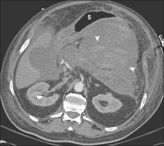 FIG 56.4, Computed tomography scan obtained 4 weeks after clinically severe gallstone pancreatitis. Note the large homogeneous fluid collection posterior to the stomach ( S ) with inhomogeneous density ( arrowheads ) suggesting solid debris.