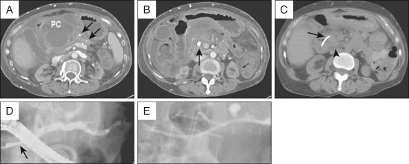 FIG 56.5, A patient with a pseudocyst caused by chronic pancreatitis. A, The pseudocyst ( PC ) is seen compressing the duodenum; calcifications are present near the tail ( arrows ). B, Lower cuts of the same patient. A large stone ( arrow ) is obstructing the main pancreatic duct. C, Follow-up computed tomography after transmural drainage and extracorporeal shock wave lithotripsy. Transduodenal stents can be seen ( arrow ). The prior stone has been fragmented ( arrowhead ). D, At the time of duodenal stent removal, pancreatography shows a stricture in the head ( arrow ). E, Stone fragments were removed, the stricture was balloon dilated, and a pancreatic duct stent was placed.