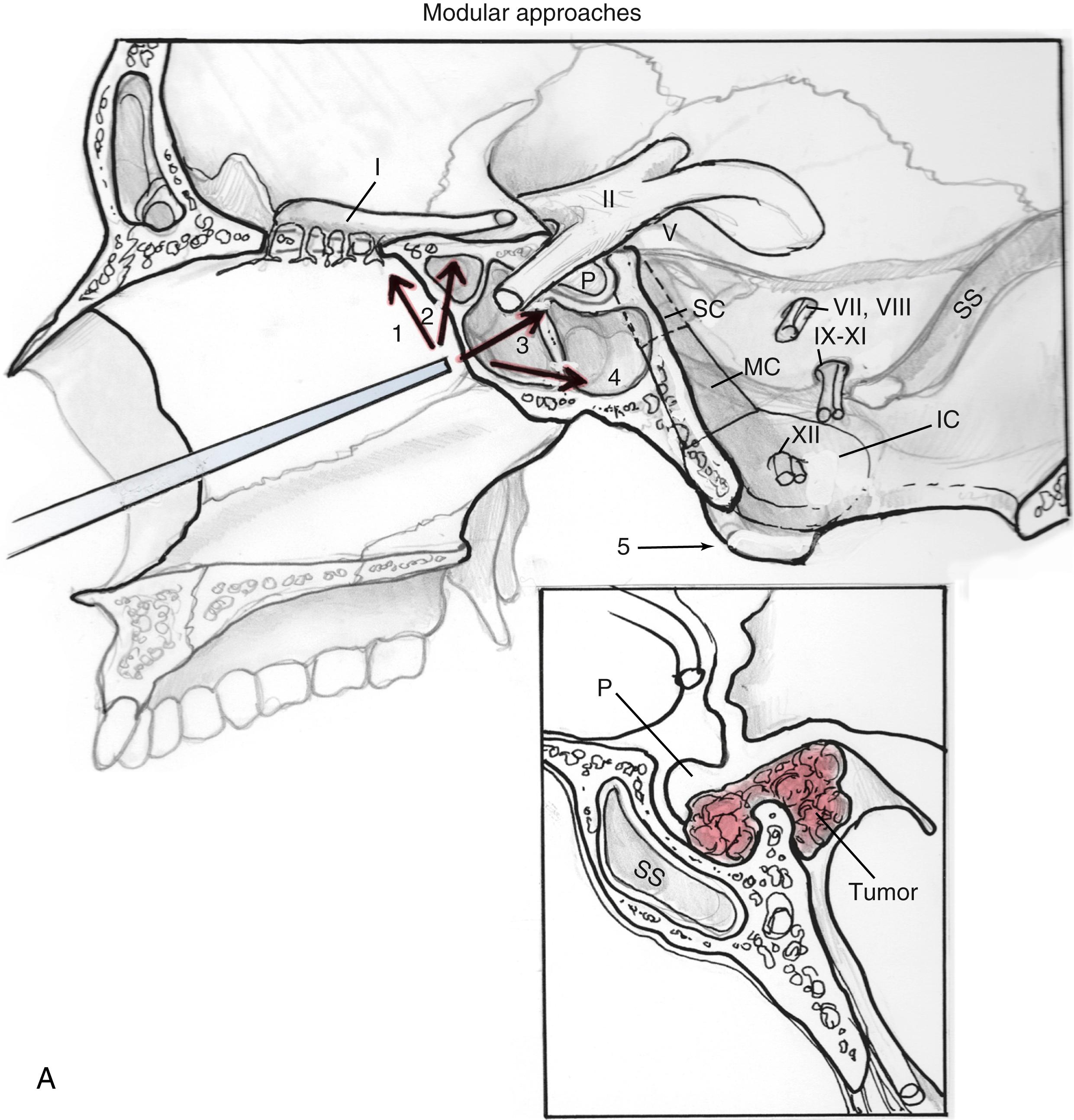 Fig. 50.1, (A) The lateral view of the sagittal plane modular expanded endonasal approaches as shown in a rostral-caudal axis. 1, Transcribriform; 2, transplanum; 3, transsellar; 4, transclival: superior, middle, inferior; 5, transodontoid. IC , inferior; MC , middle; SC , superior; P, pituitary; SS, sigmoid sinus. (B) The view of the anterior skull base from above showing sample tumor locations for the various rostral-caudal modules. Tumor locations: 1, Near cribriform plate (ethmoid); 2, suprasellar near anterior clinoid; 3, optic chiasma, and CN II; 4, pituitary gland; 5, dorsum sellae; 6, post-clinoid process; 7, cavernous sinus; 8, clivus. IC , Inferior; MC , middle; SC , superior; SS , sphenoid sinus.