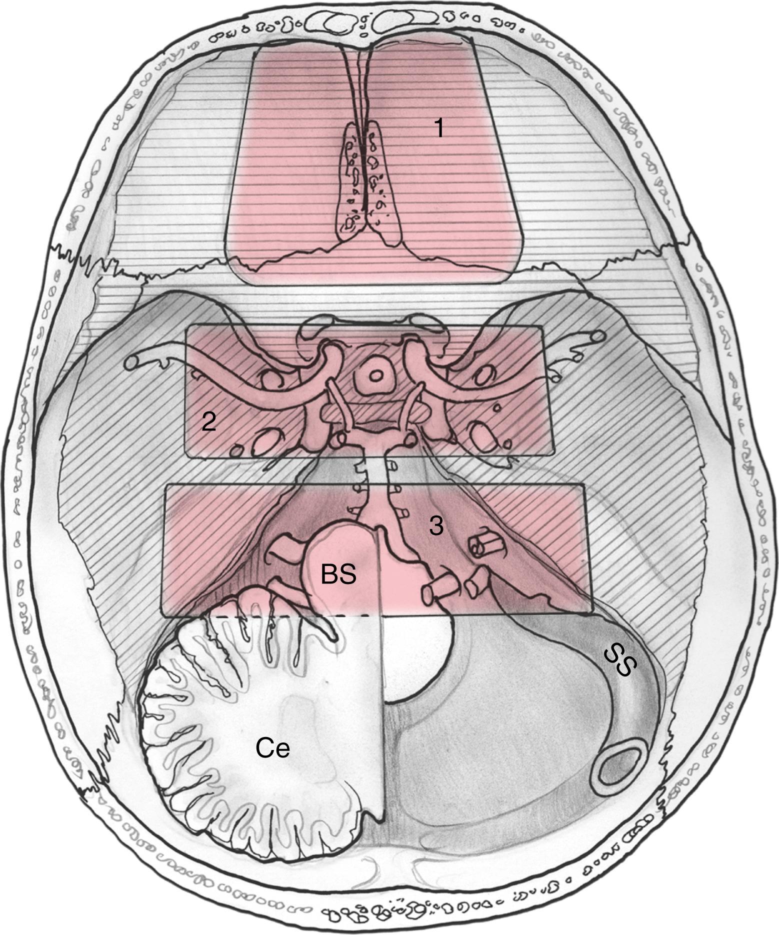 Fig. 50.2, The superior view of the skull base with general regions of approach by fossa. The rectangles designate the areas of approach by fossa. 1, Anterior fossa; 2, middle fossa; 3, posterior fossa. BS , Brainstem; Ce , cerebellum; SS , sphenoid sinus.