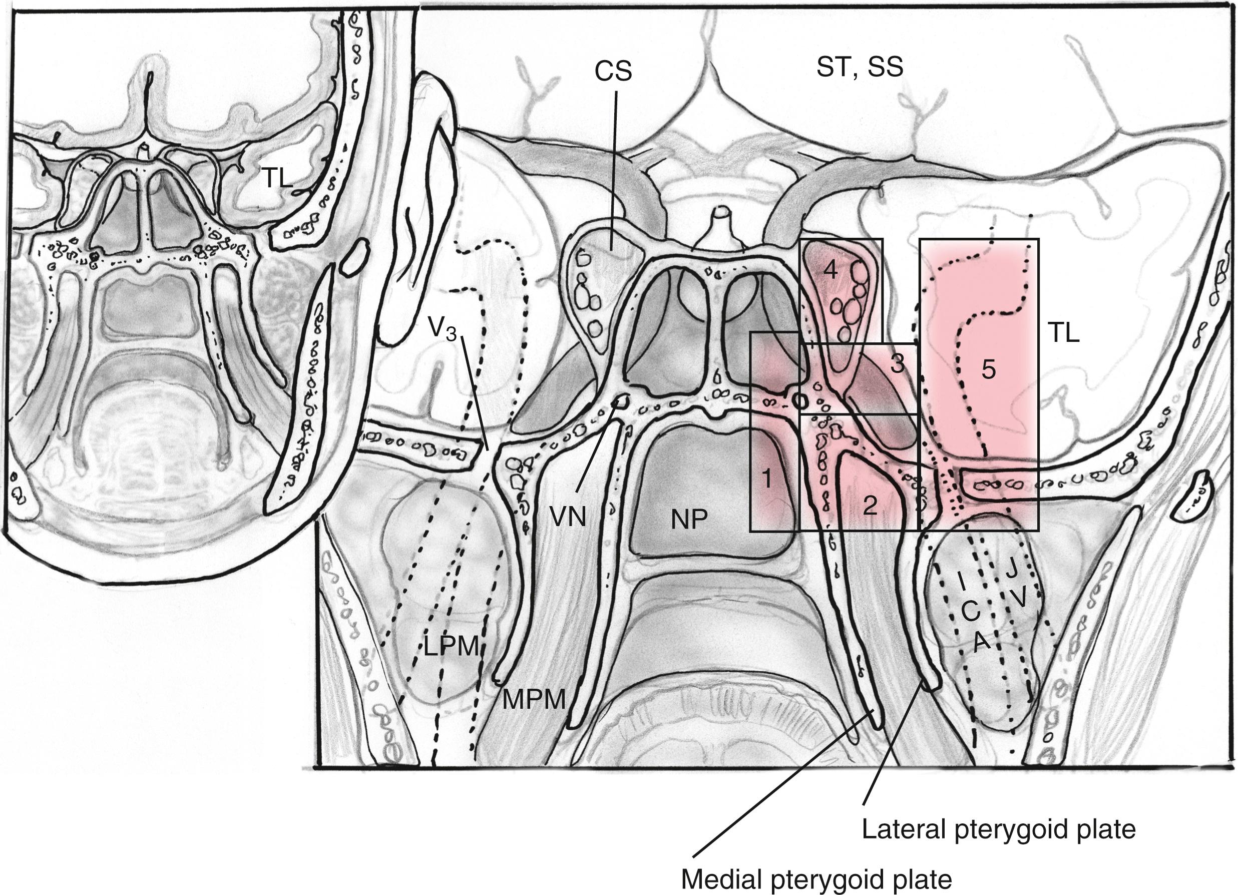 Fig. 50.3, Coronal plane, lateral expanded endonasal approaches by anatomical zones. Zone 1 is the petrous apex, zone 2 the petroclival junction, zone 3 is the quadrangular space/Meckel cave, zone 4 is the superior lateral cavernous sinus, and zone 5 is the infratemporal fossa. CS , Cavernous sinus; ICA , internal carotid artery; JV , jugular vein; NP , nasopharynx; LPM/MPM, lateral and medial pterygoid muscles; SS , sphenoid sinus; ST, sella turcica; TL , temporal lobe; VN , vidian nerve; V 3 , V 3 in foramen ovale.