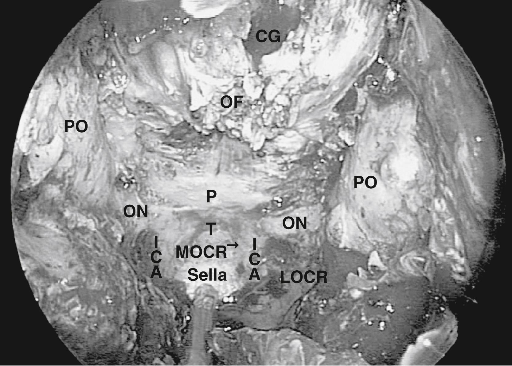 Fig. 50.4, The intraoperative, endoscopic view of the entire anterior skull base following exposure and removal of necessary bone for approach to an anterior base lesion. CG , Crista galli; ICA , internal carotid artery; LOCR , lateral opticocarotid recess; MOCR , medial opticocarotid recess; OF , olfactory filament; ON , optic nerve protuberance; P, planum; PO, periorbita; T, tuberculum.