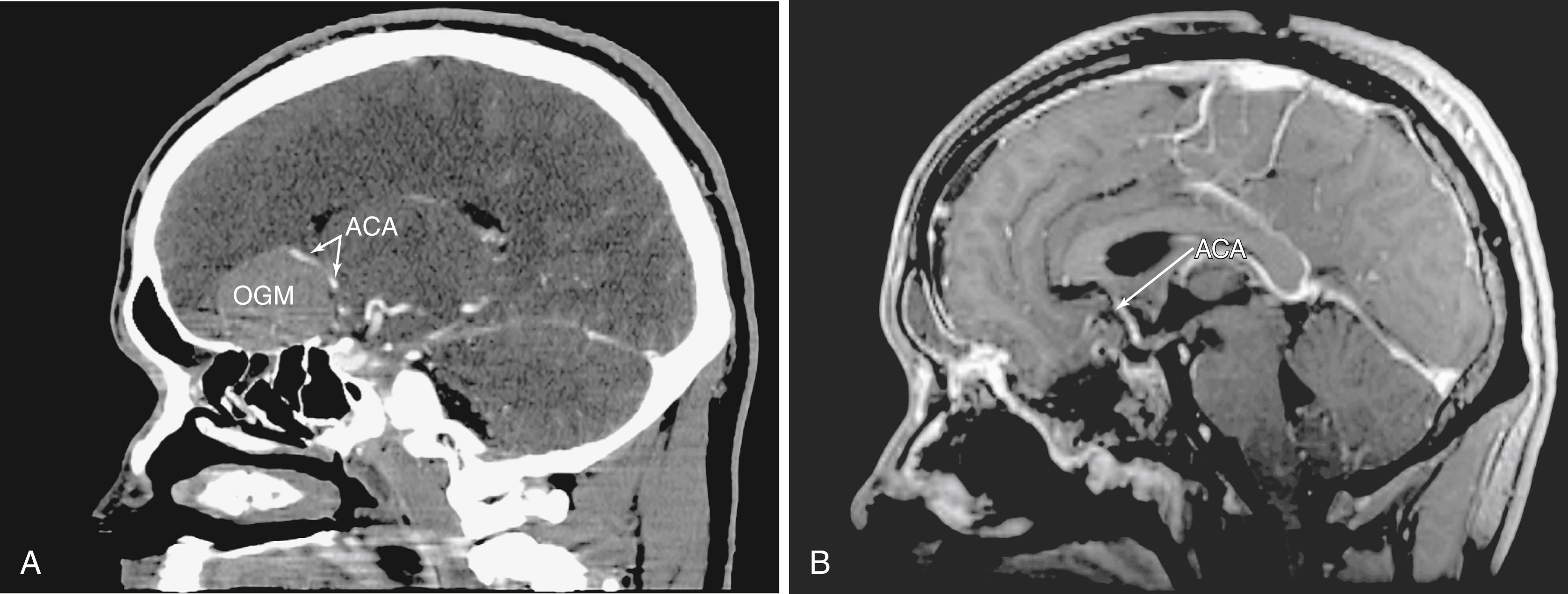 Fig. 50.5, (A) Preoperative computed tomographic angiography sagittal reconstruction showing the anterior cerebral artery (ACA) involvement with an olfactory groove meningioma (OGM). (B) Postoperative sagittal magnetic resonance imaging following an expanded endonasal approach showing complete resection of the tumor with patent and intact ACA.