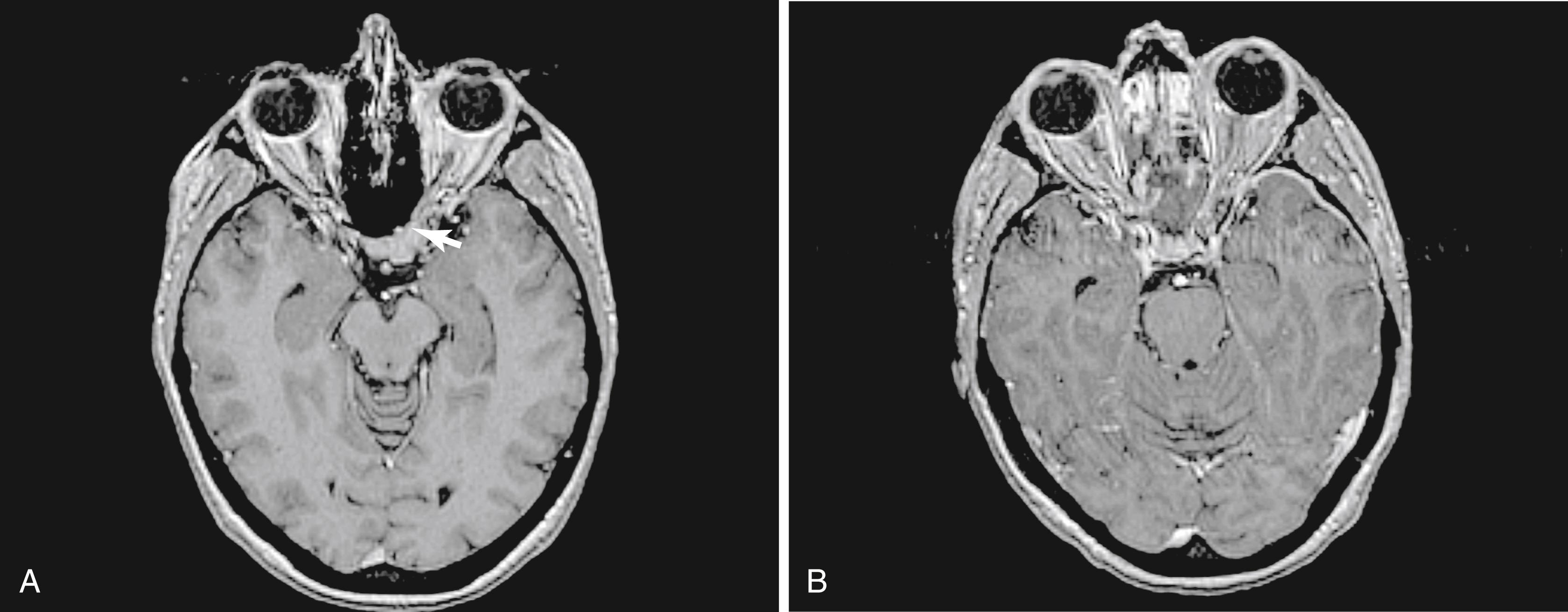 Fig. 50.6, (A) Axial, postcontrast magnetic resonance image (MRI) showing extension of meningioma into the left medial optic canal ( arrow ). (B) Axial, postcontrast MRI following an expanded endonasal approach for meningioma showing the resection of the tumor from the medial optic canal ( arrow ).