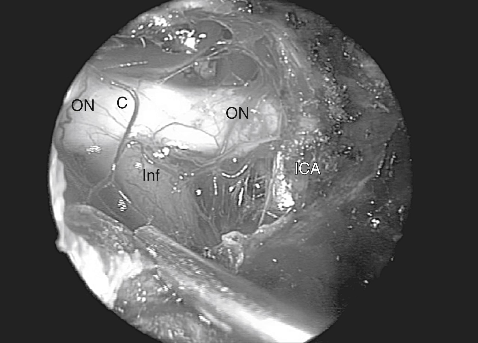 Fig. 50.7, Endoscopic, endonasal view following resection of a suprasellar meningioma. The tumor is debulked and the following structures identified in succession: C, chiasm; ICA, supraclinoid internal carotid artery; Inf, infundibulum; ON, optic nerves.