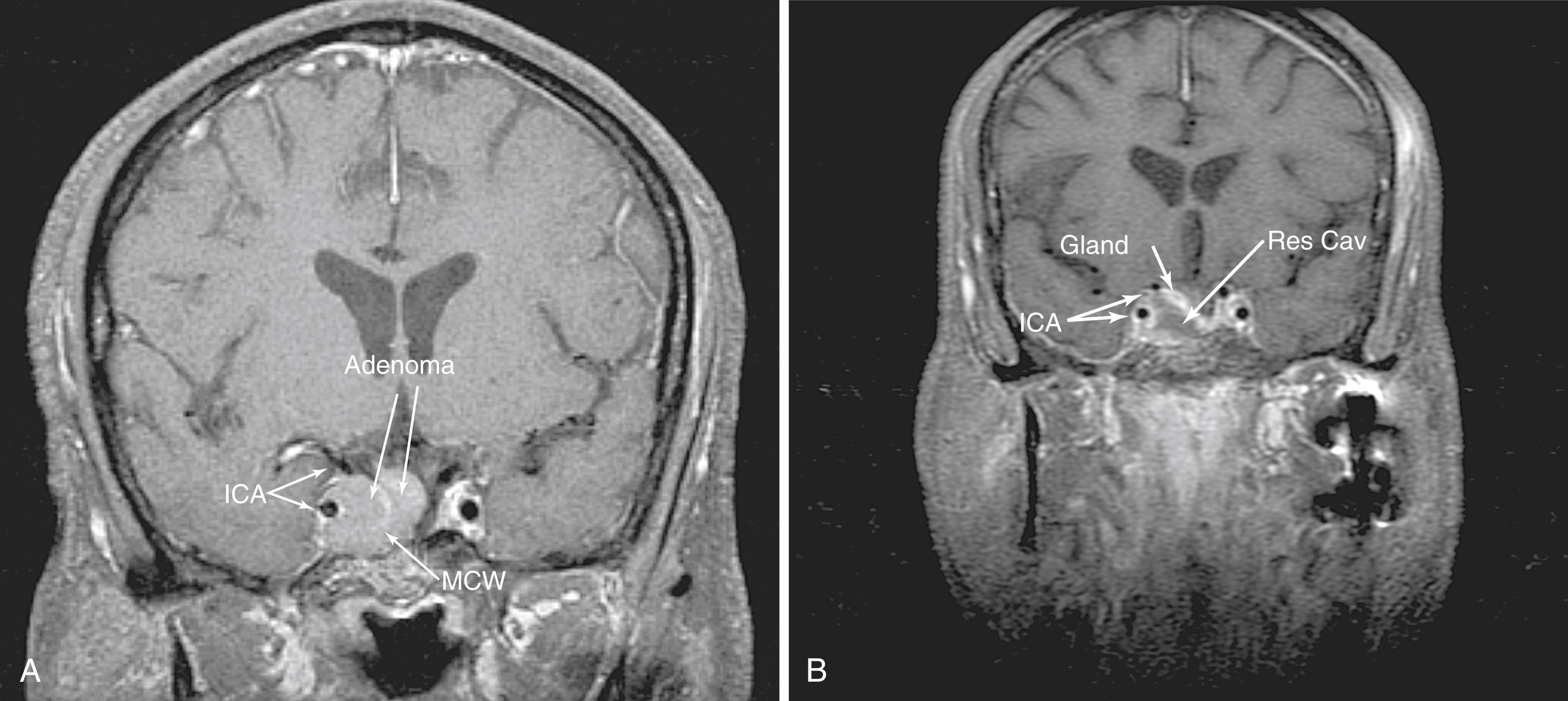 Fig. 50.8, (A) A preoperative, contrast-enhanced coronal magnetic resonance image (MRI) showing recurrent pituitary adenoma largely involving the medial cavernous sinus, as evidenced by the enhancing medial cavernous wall (MCW). (B) Postoperative, contrast-enhanced, coronal MRI showing complete resection of the tumor, including the portion in the medial cavernous sinus. The remaining pituitary gland and normal cavernous sinus contents are more apparent following tumor resection. ICA, Cavernous internal carotid artery; MCW, medial cavernous wall; Res Cav, tumor resection cavity.