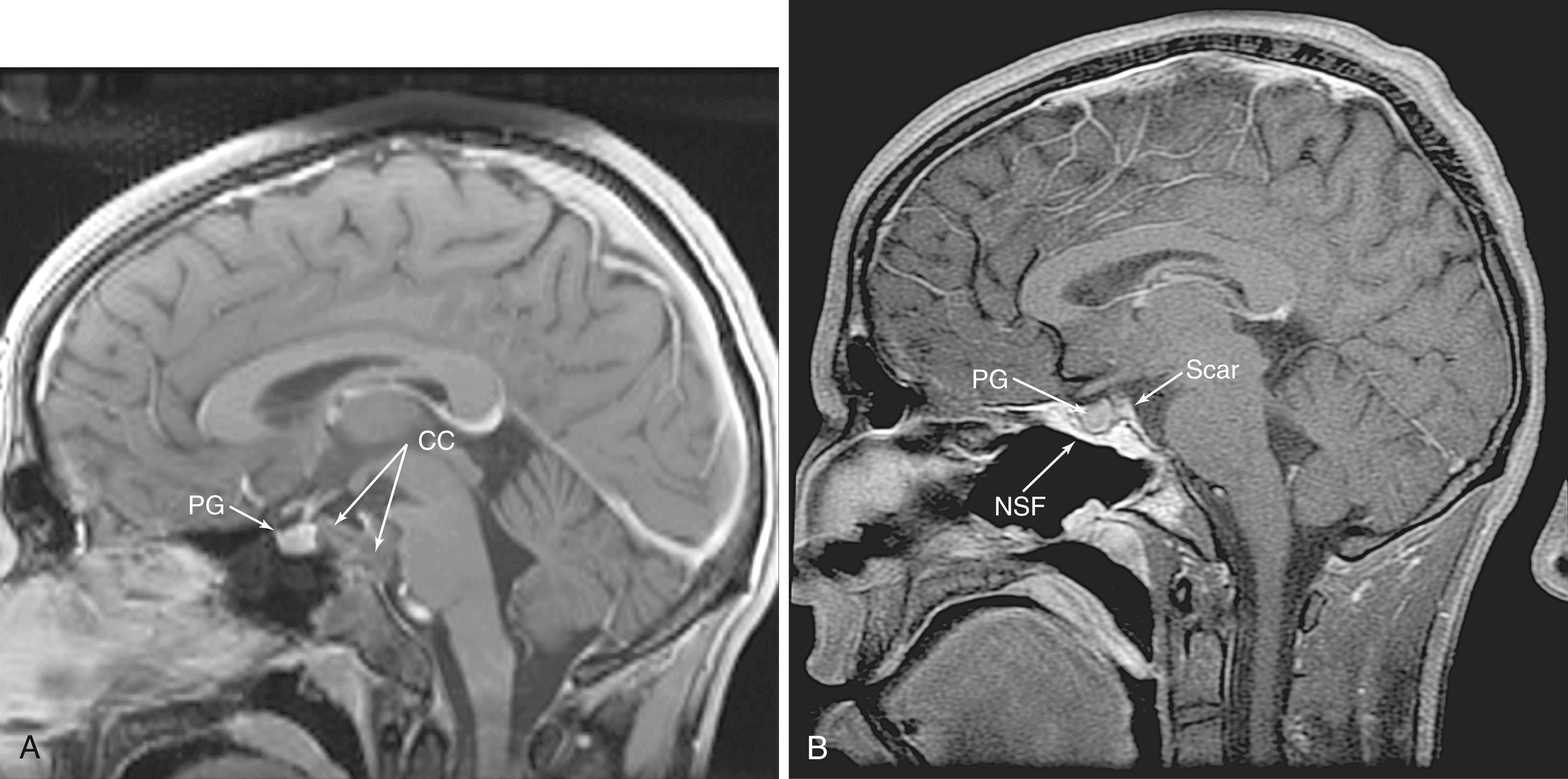 Fig. 50.9, (A) A sagittal postcontrast magnetic resonance image (MRI) showing a superior clival chordoma (CC) with extension behind the pituitary gland (PG) into the dorsum sellae. (B) A postoperative MRI following the expanded endonasal approach to the lesion in (A) showing the complete resection of the superior clival lesion, which involved a pituitary transposition, as evidenced by the scar tissue posterior to the gland (PG). There is a brightly enhancing nasoseptal flap (NSF) in place for reconstruction.