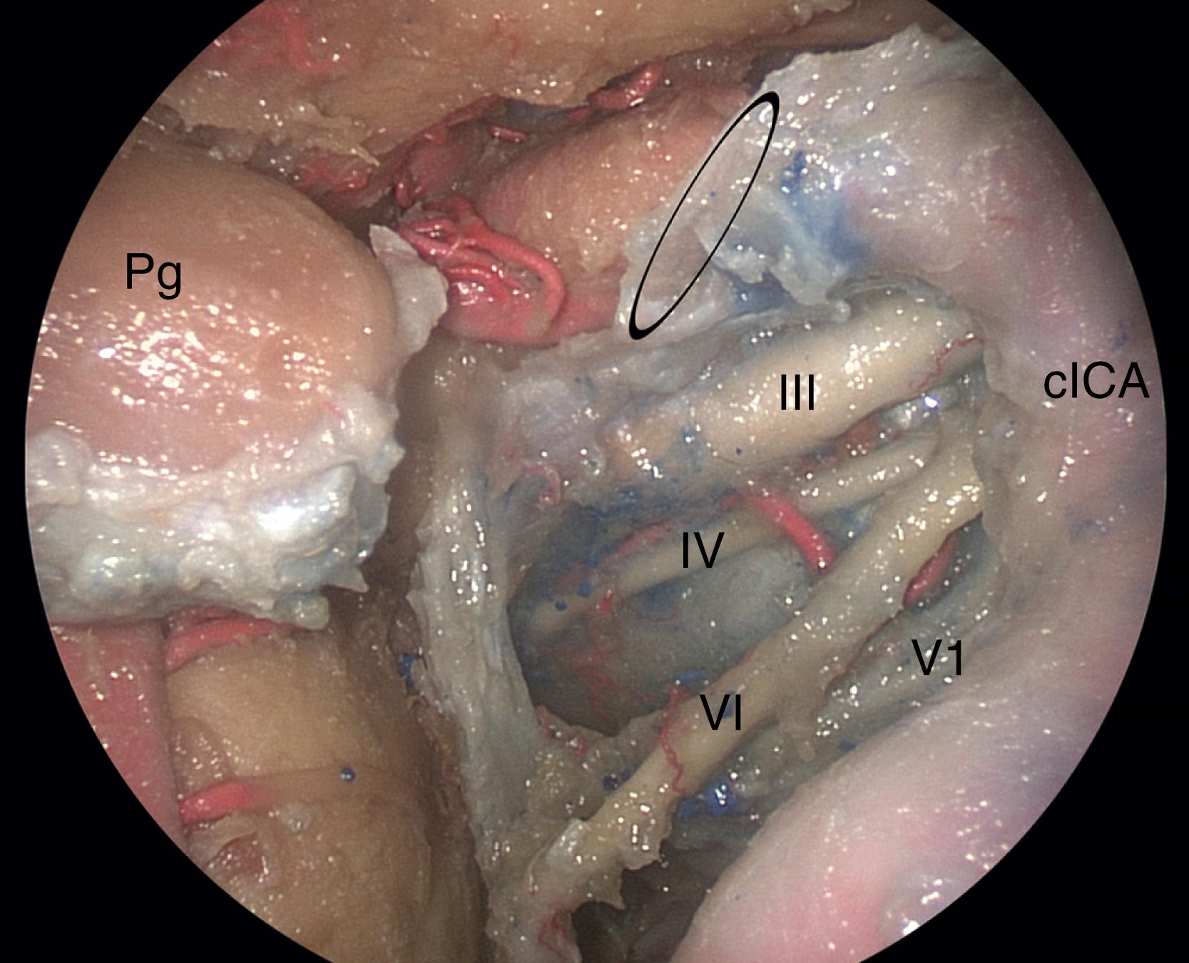 FIGURE 13.1, The lateral cavernous sinus as viewed through the more familiar medial compartment, using a standard endoscopic endonasal transsphenoidal transsellar approach with an angled endoscope. This provides a satisfactory view of the lateral cavernous sinus contents, but surgical manipulation is difficult unless the lesion addressed is soft and easily removed with an angled suction (such as a pituitary adenoma that has invaded the lateral compartment from the medial compartment). The working space is behind the cavernous internal carotid artery and requires angled instruments. For firm lesions such as meningiomas, the en-face view and surgical freedom afforded by the transpterygoid approach to the lateral compartment are superior. In this view, the bone of the clivus has also been removed, allowing visualization of most of the course of the abducens nerve. III , Oculomotor nerve; IV , trochlear nerve; V1 , ophthalmic division of trigeminal nerve; VI , abducens nerve; cICA , cavernous internal carotid artery; ellipse , distal dural ring of carotid artery; Pg , pituitary gland.