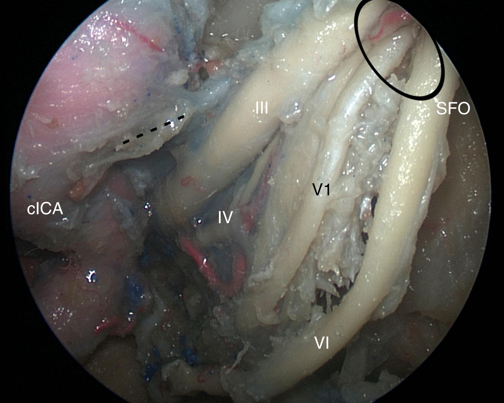 FIGURE 13.4, Similar projection to Fig. 13.2 , after inferior mobilization of abducens nerve to better visualize the lateral cranial nerves within the lateral wall of the cavernous sinus. III , Oculomotor nerve; IV , trochlear nerve; V1 , ophthalmic division of trigeminal nerve; VI , abducens nerve; cICA , cavernous internal carotid artery; SOF (ellipse) , superior orbital fissure. Dashed line , roof of cavernous sinus (distal dural ring of carotid artery).