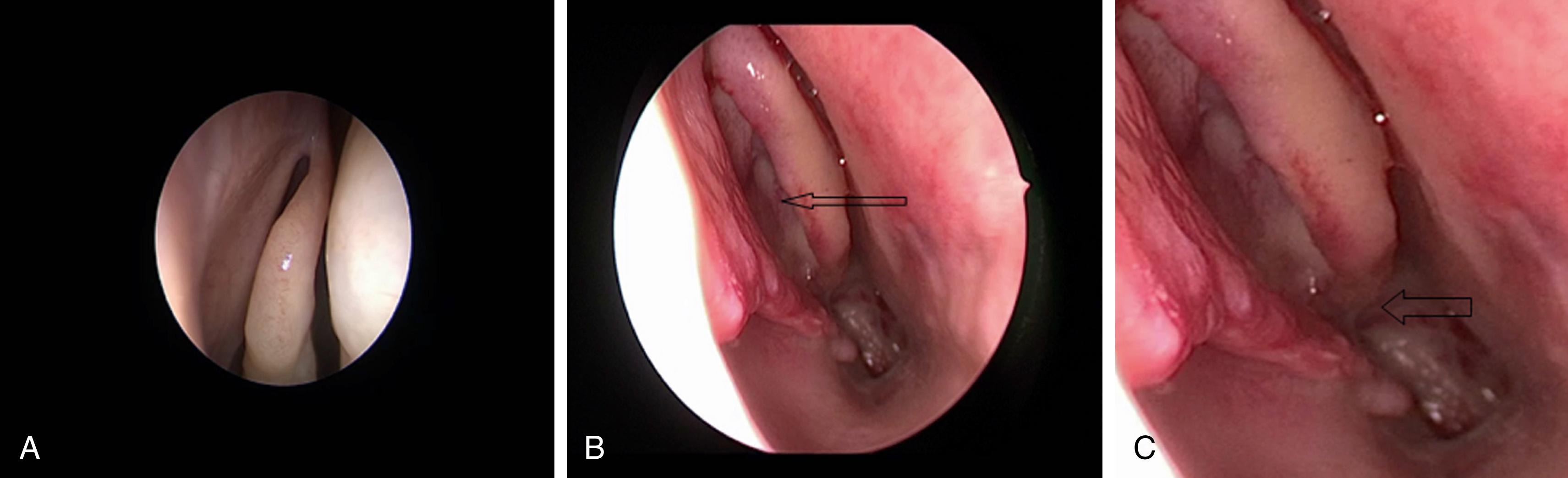 FIGURE 12.2, Endoscopic view of the middle turbinate. (A) Parasagittal plane: Anterior vertical portion of the middle turbinate. (B) Coronal plane: Vertical portion of the middle turbinate basal lamella. (C) Axial plane: Horizontal portion of the middle turbinate basal lamella.