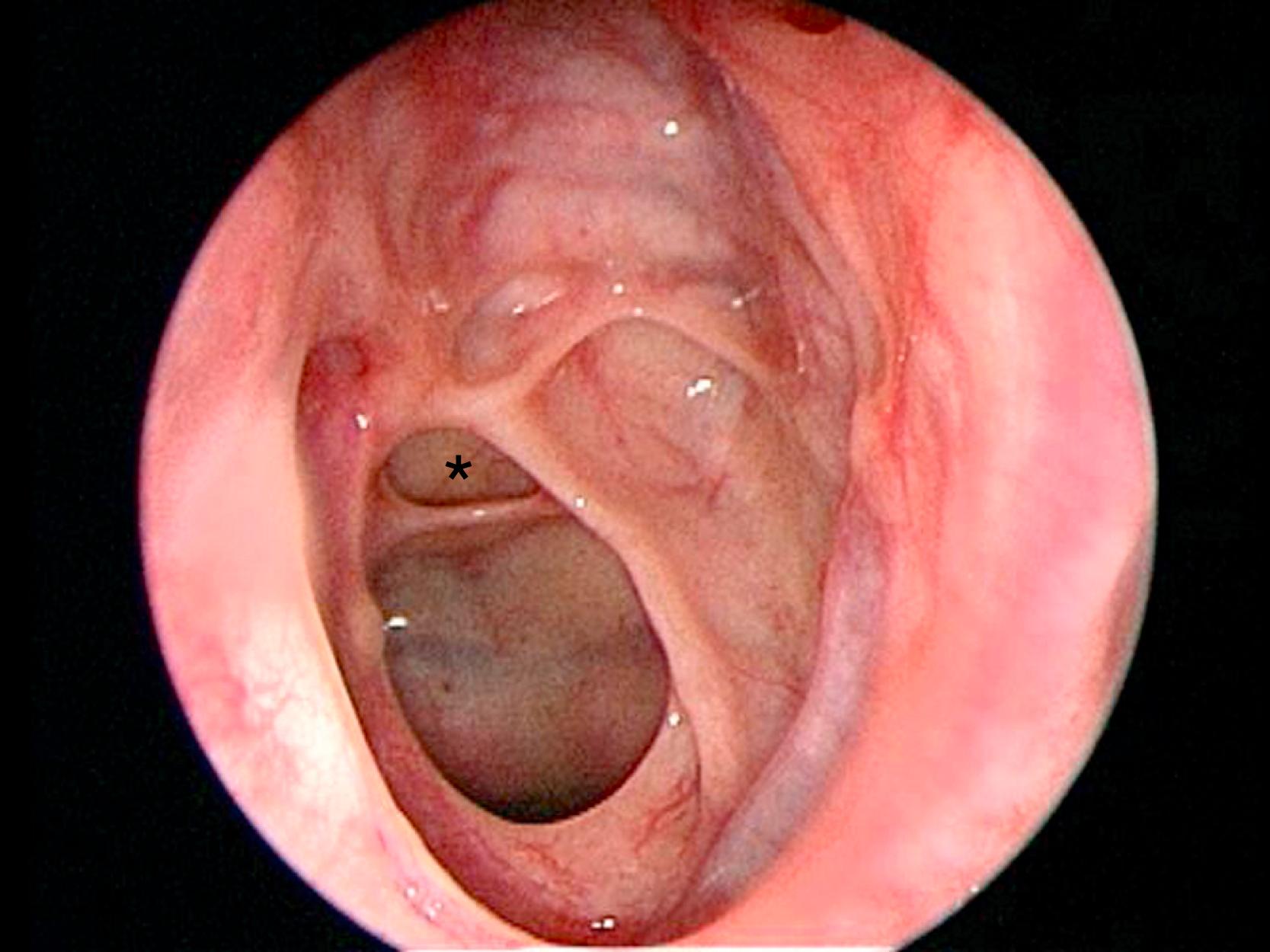 FIGURE 12.3, Endoscopic view of sphenoethmoid cell (Onodi cell). Identified by the asterisk (∗).