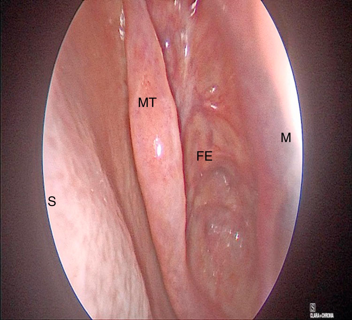 FIGURE 12.4, Endoscopic view of fovea ethmoidalis. The roof of the ethmoid sinus is formed by the orbital plate of the frontal bone medial to the cribriform sinus. (S) Septum, (MT) middle turbinate, (FE) fovea ethmoidalis, and (M) maxillary sinus.