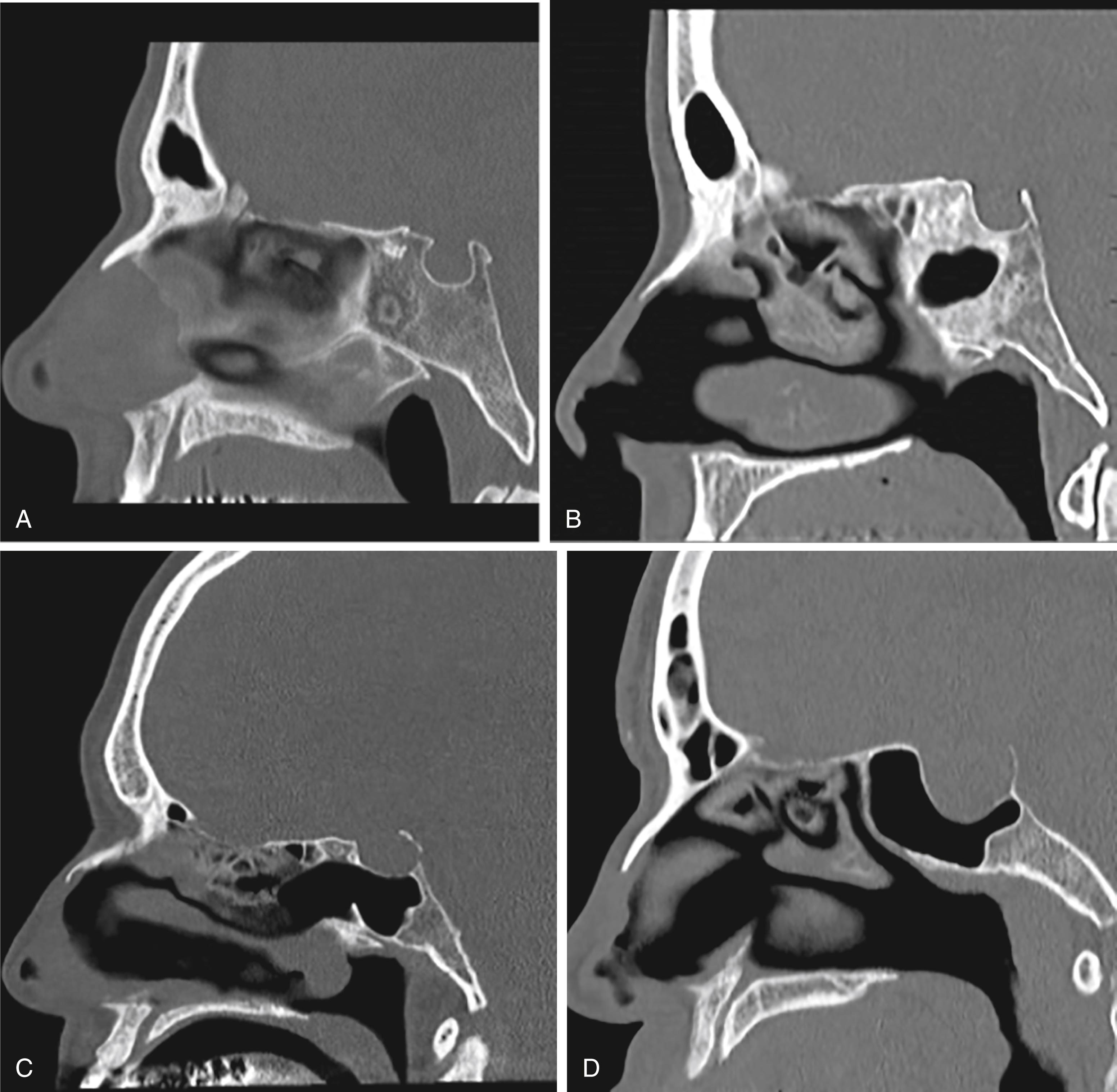 FIGURE 12.5, Classification of sphenoid pneumatization. (A) Concha classification has little to no pneumatization. (B) Presellar classification refers to pneumatization up to the anterior margin of the sella, without a defined clival region. (C) Sellar pneumatization extends anterior and posterior to the sella turcica. (D) Postsellar classification describes pneumatization similar to sellar pneumatization with the addition of pneumatized space in the dorsum sellae.