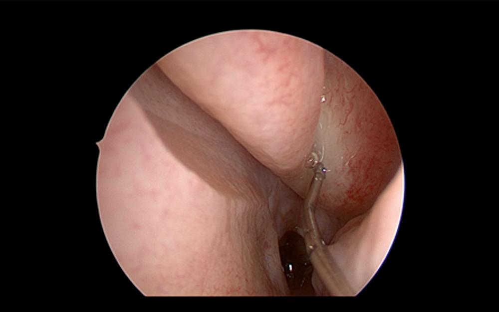 FIGURE 12.7, Endoscopic view of sphenopalatine foramen. Location for injection of the sphenopalatine foramen just anterior to the attachment of the horizontal portion of the basal lamella. LNW , Lateral nasal wall; MT , middle turbinate.