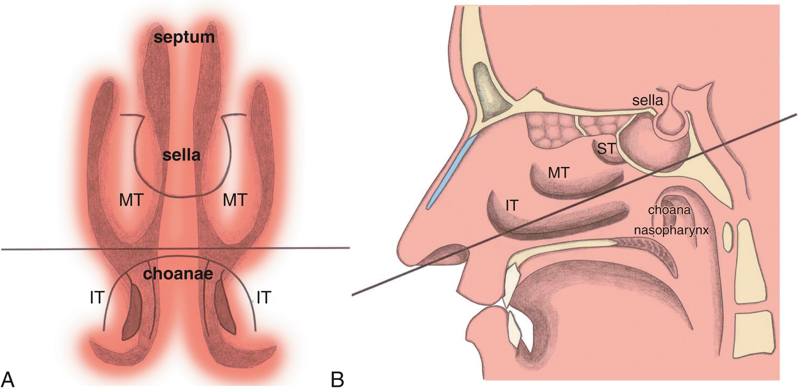 FIGURE 15.1, Schematic drawings of the sinonasal cavity, coronal (A) and sagittal (B) views, demonstrate the anatomic landmarks leading to the sella. The inferior turbinate (IT) and middle turbinate (MT) are initially encountered along the endonasal route. A plane followed along the inferior margin of the middle turbinate leads to the clivus approximately 1 cm inferior to the floor of the sella, and just inferiorly is the upper margin of the choana with view of the nasopharynx that serves as a key surgical landmark. Confirmation of the middle turbinate in relation to the nasopharynx obviates confusion of the middle turbinate with the superior turbinate (ST) , which is especially important in occasional cases of an anatomic supreme turbinate.