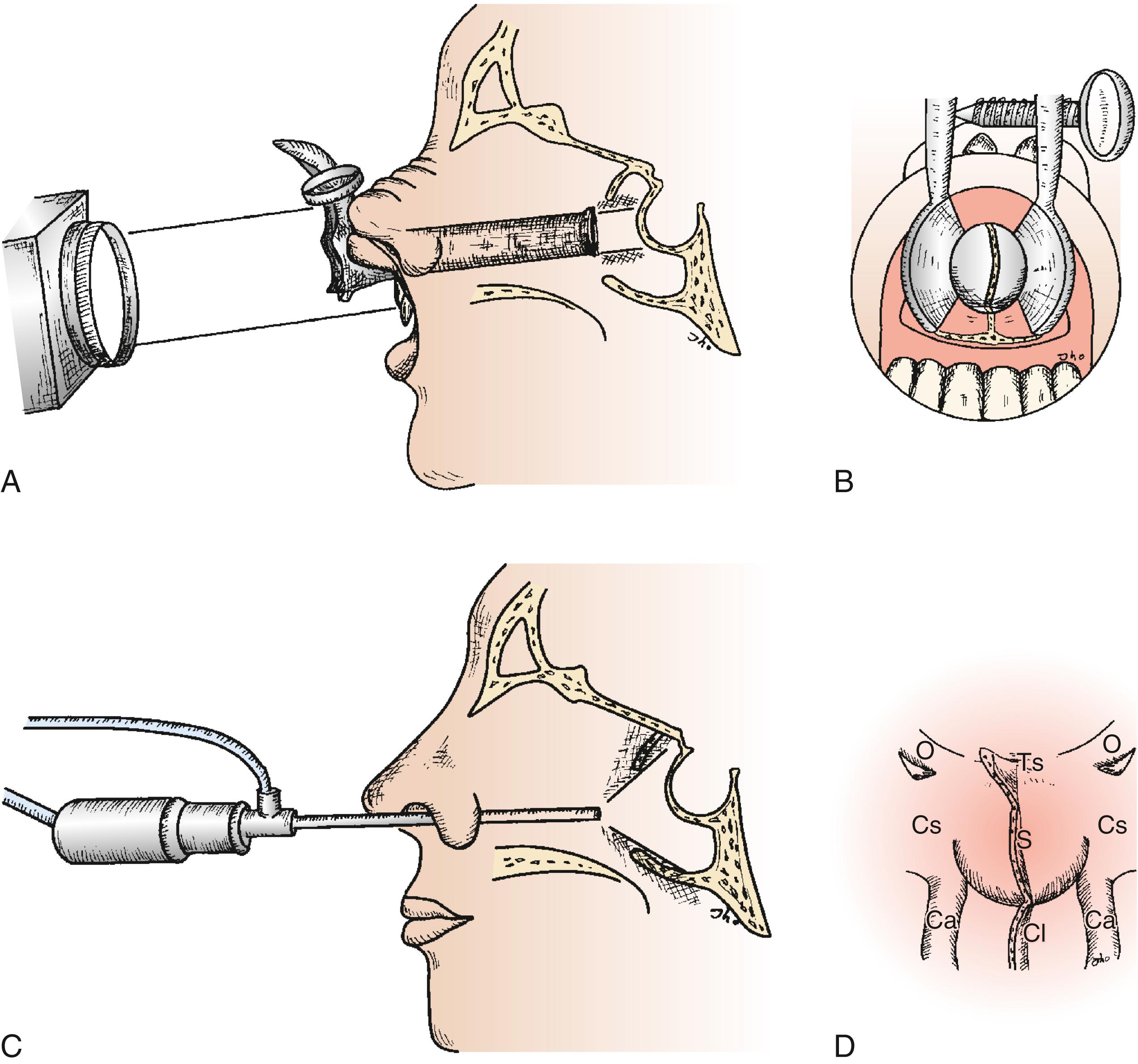 FIGURE 15.2, Schematic drawings demonstrate comparison views between microscopic and endoscopic exposure at the posterior wall of the sphenoid sinus during transsphenoidal pituitary surgery. The microscope view is stereoscopic but can be confined by the narrow tubular corridor for light projection to a central limited area of the sella (A and B). The endoscope view is monoscopic but reveals a wide region of the sphenoid sinus posterior wall due to the panoramic nature of endoscopic optics (C and D). The endoscope also has capabilities for dynamic visualization using freedom of endoscope movement at the surgical site and extra options for angled lenses. However, the endoscope lens does produce a degree of fish eye effect with the center being maximally magnified and the periphery somewhat contracted. Endoscopic view demonstrates the sella (S) at the center, cavernous sinuses (Cs) laterally, the cavernous carotid arteries (Ca) inferolaterally, clivus (Cl) inferiorly, tuberculum sella (Ts) superiorly, and optic nerves (O) superolaterally.