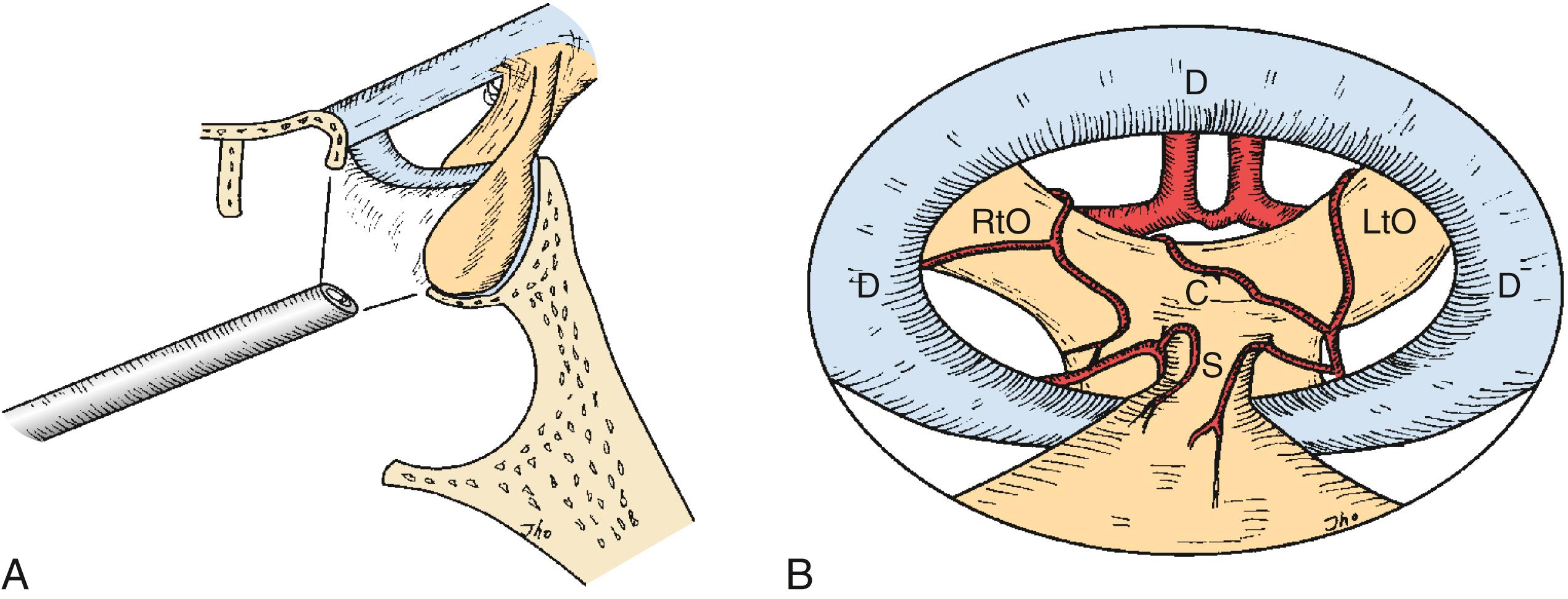 FIGURE 15.3, Schematic drawings show angled views with the 30-degree-lens endoscope directed toward the suprasellar region (A and B). The 30-degree-lens endoscopic view discloses the anterior cerebral artery, optic chiasm (C) , diaphragma sella (D) , left optic nerve (LtO) , right optic nerve (RtO) , and pituitary stalk (S) .