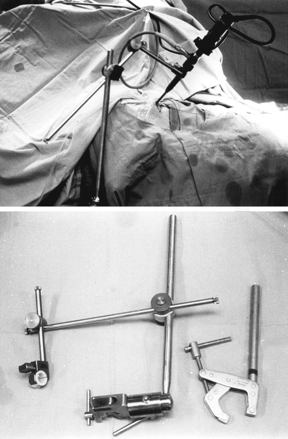 FIGURE 15.5, The endoscope holder consists of a custom-made distal joint in combination with a Greenberg retractor mounting system. The holder provides rigid fixation of the endoscope (akin to a video camera tripod) during specific portions of surgery such as drilling or tumor removal, to provide stable video images as well as bimanual capabilities for a lone surgeon to use surgical instruments. The holder is setup along a parallel trajectory with the surgical route to allow a smooth range of endoscope depth changes. The ergonomics of the customized holder also allows easy alternation between endoscope stabilization in the holder and single-handed endoscope steering as needed for dynamic surgical visualization or view adjustments during the operation.