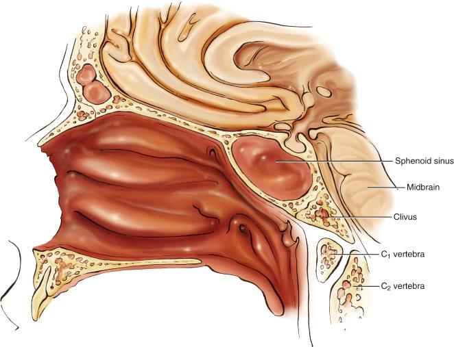 Fig. 30.1, Drawing of bony and soft tissue paraclival anatomy in the sagittal view. The clivus is seen with its surrounding structures: nasopharynx anteriorly, midbrain and brainstem posteriorly, sphenoid sinus and pituitary sella superiorly, and C 1 inferiorly.