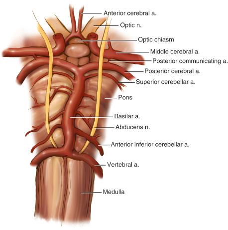 Fig. 30.2, Drawing of the cranial anatomy posterior to the clivus in coronal view. a., Artery; n., nerve.