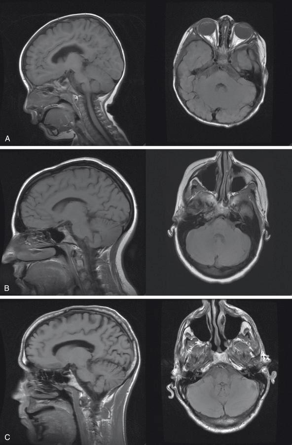 Fig. 30.4, Sagittal and axial T1-weighted noncontrast-enhanced magnetic resonance images illustrating age-dependent changes in the clivus. Images show the appearance of a normal clivus in patients aged 1 year (A) , 20 years (B) , and 50 years (C) . Note the increased signal intensity of the clivus with time, which is caused by an increase in the proportion of yellow (fatty) replacement of the marrow.