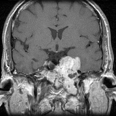 Fig. 30.6, Coronal T1-weighted, contrast-enhanced magnetic resonance image of a skull base chondrosarcoma involving the petroclival synchondrosis with temporal lobe compression. This asymmetric aggressive chondrosarcoma has produced skull base erosion and left internal carotid artery displacement. The petroclival synchondrosis is the typical site of origin of this rare lesion.